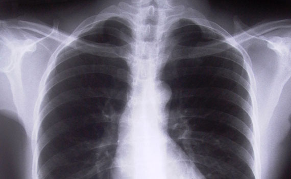 Chest X-ray